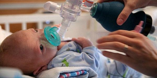 Menyayat Hati, Bayi Eli Tanpa Hidung Harus Berjuang untuk 'Bernapas' Sejak Lahir