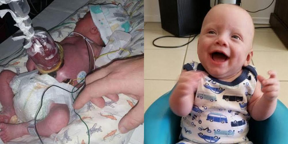 Bayi Ini Terlahir dengan Usus Terburai, Tapi Kini Hidup Normal!