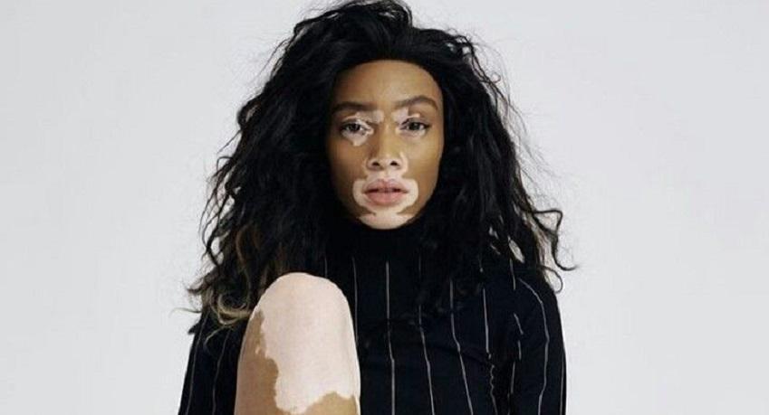 13 Wanita Vitiligo Ini Buktikan Cantik Itu Tak Harus Sempurna