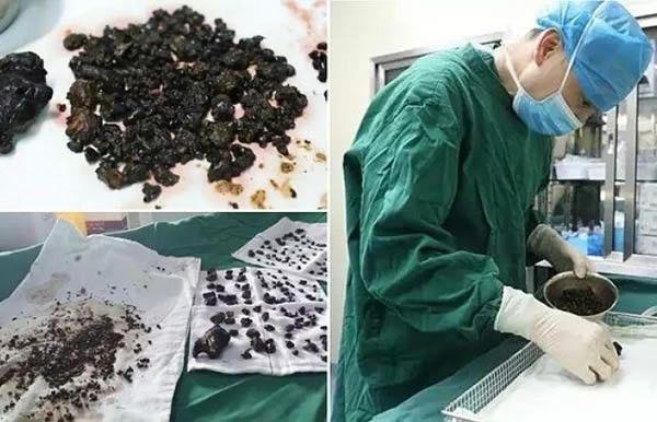 4 Operasi Tergila yang Pernah Dilakukan Dokter, Bikin Merinding!