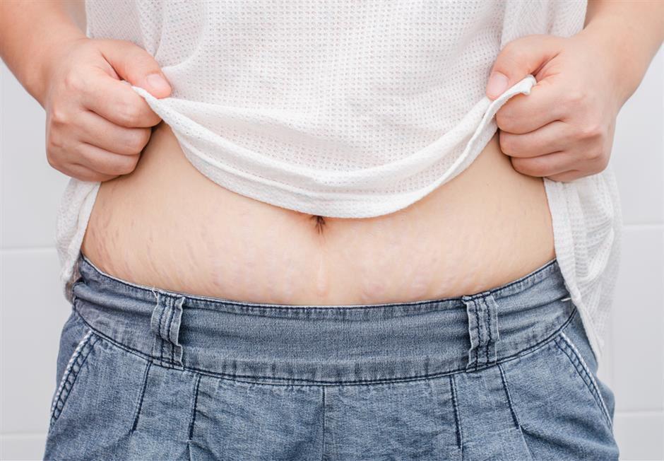 Apa Jadinya Bila Stretch Mark Dilukis? Seperti Deretan Foto Ini