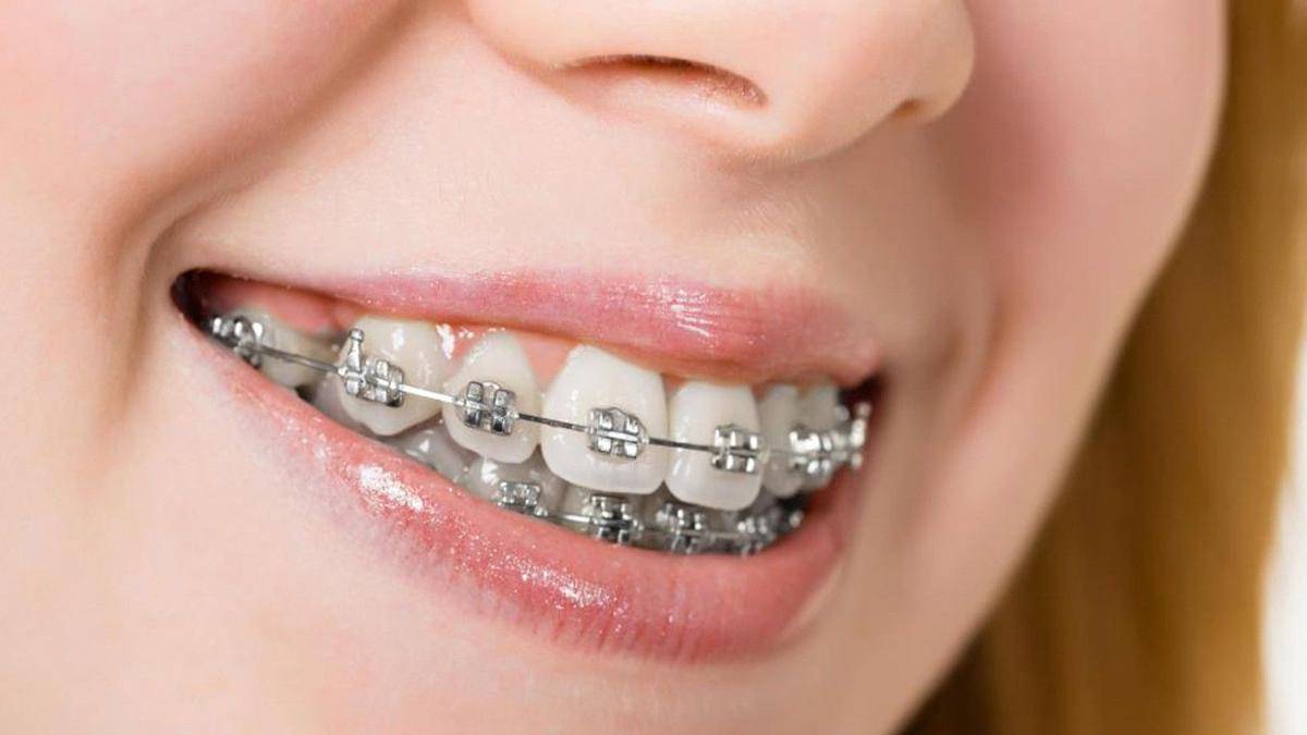 ww.bestsmilebraces.com