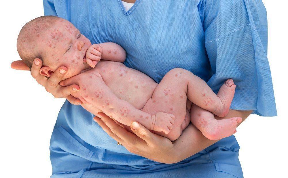 58 Anak di Bima Terjangkit Penyakit Campak Sejak Januari 2023