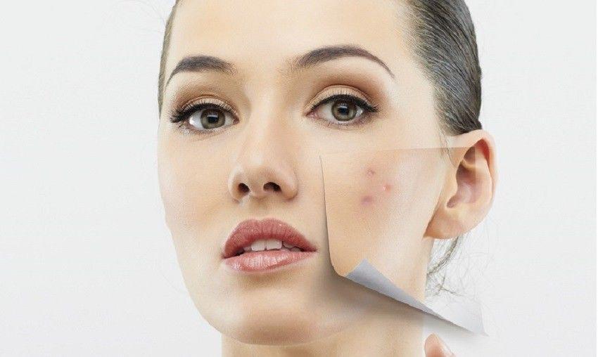 Punya Kulit Rentan Berjerawat? Hindari 5 Bahan Skincare Ini, Girls