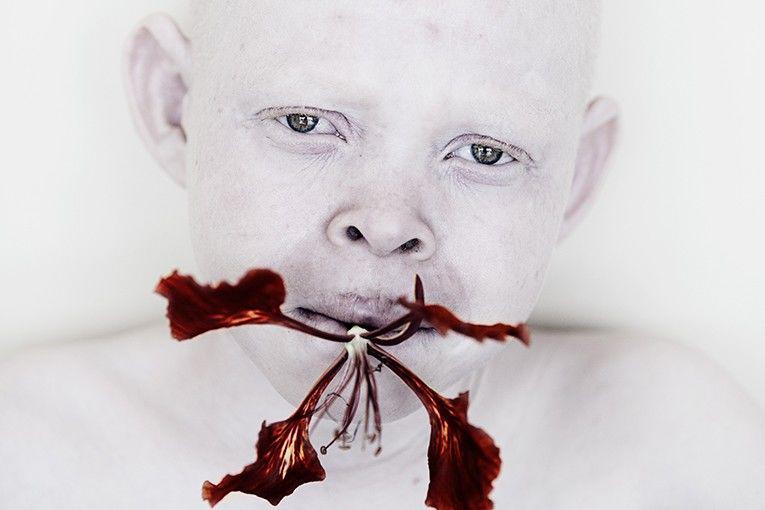 Kisah Pilu Anak Albino Dibunuh Karena Dianggap Kutukan