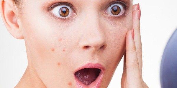 5 Tipe Jerawat di Wajah dan Cara Mengatasinya