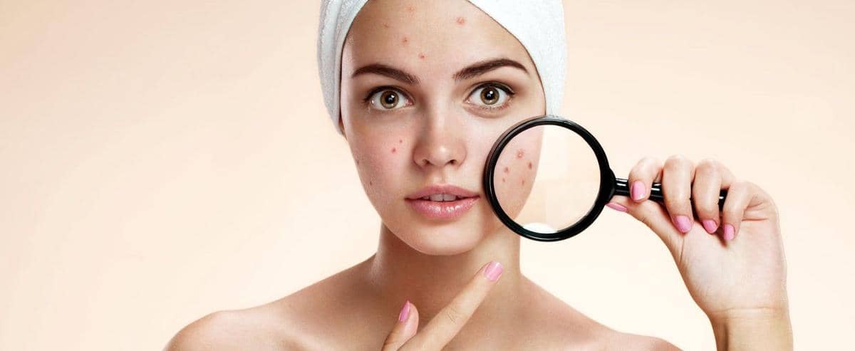 Jangan Dipencet! 5 Hal Ini Perlu Kamu Perhatikan Saat Ada Jerawat Batu