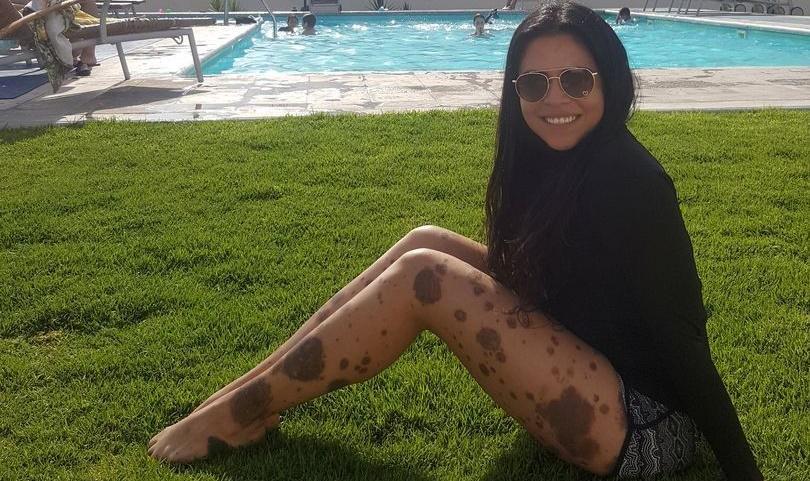 Perempuan Ini Dibully Netizen Gara-gara Dianggap Mirip Anjing "Dalmatian"