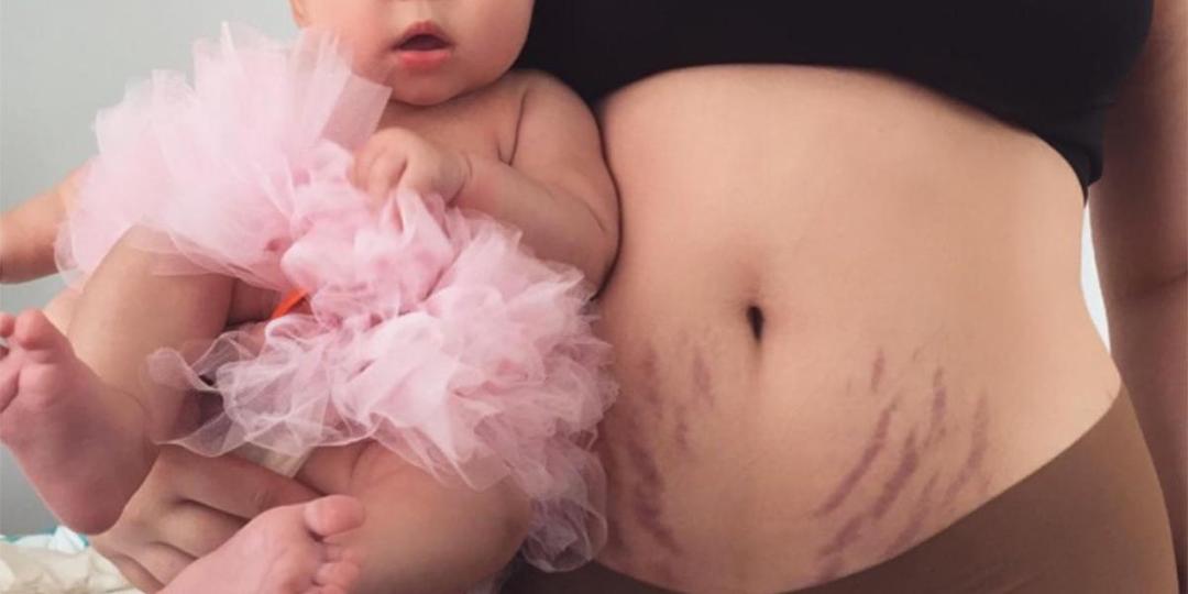 Tanpa Bahan Kimia, 5 Cara Alami Ini Ampuh Hilangkan Stretch Marks