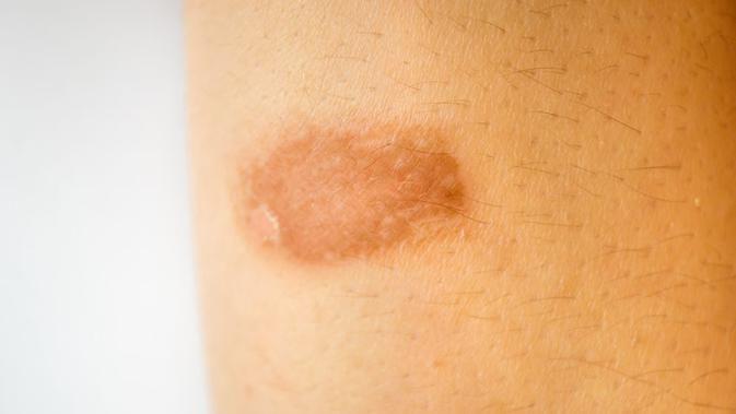 5 Tips Ampuh Hilangkan Bekas Luka Knalpot, Bisa Pakai Bahan Alami!