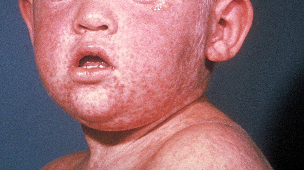 ilustrasi rubella (tecake.in)