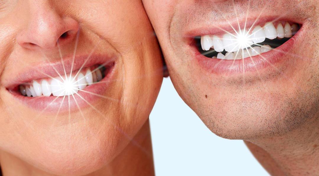 Ingin Memutihkan Gigi? Ini 5 Perbedaan Teknik Veneer dan Whitening