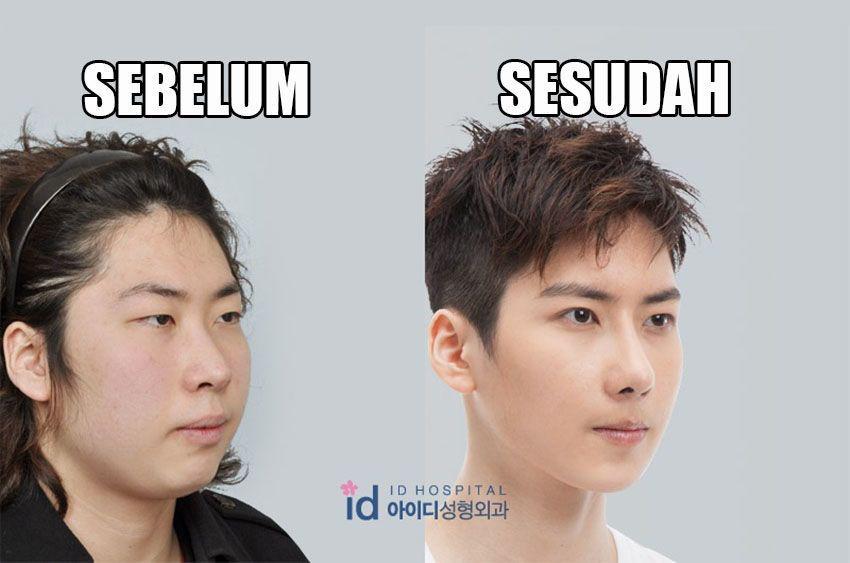 15 Foto Sebelum & Sesudah Oplas Cowok Korea, Jadi Setampan Lee Min Ho