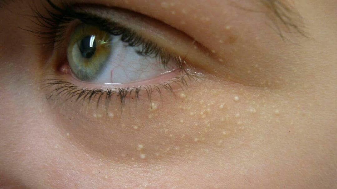5 Fakta Milia, Benjolan Kecil di Area Mata yang Bisa Ganggu Makeup