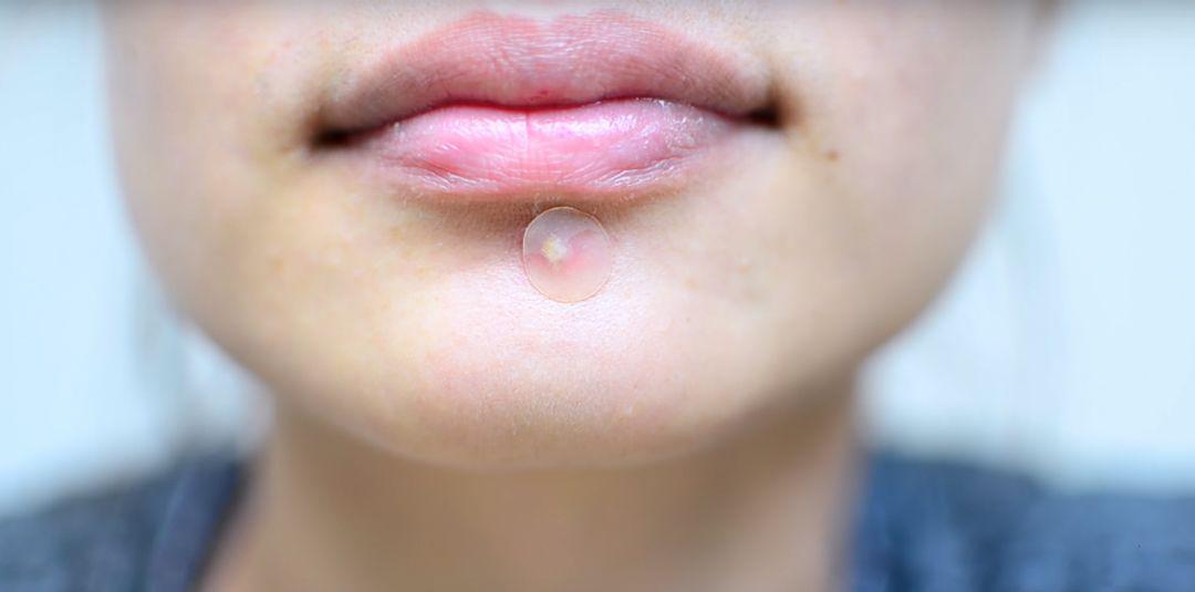 5 Rekomendasi Acne Patch yang Bisa Menutupi Jerawatmu