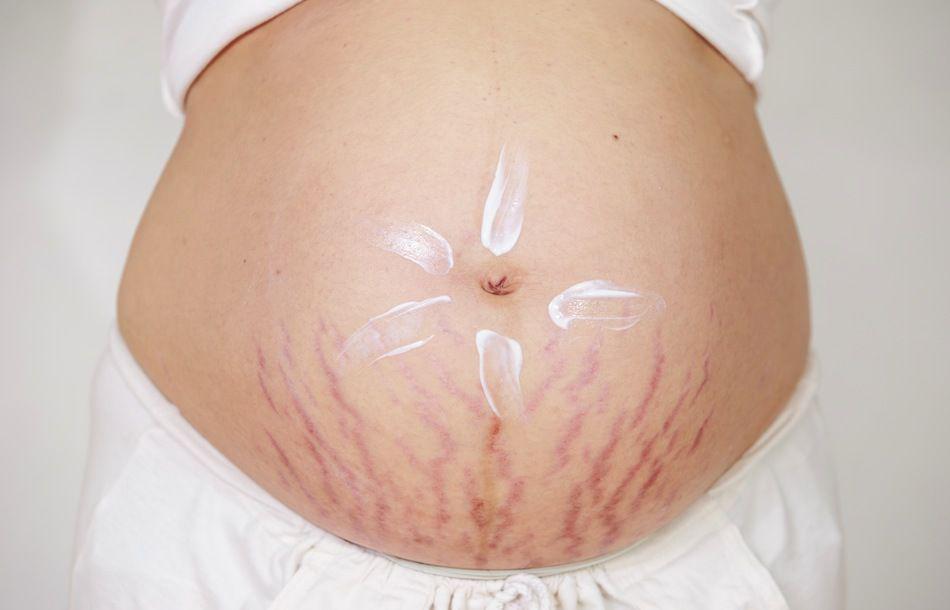 Kamu Hamil? Siap-siap Cegah Stretch Mark dengan 6 Cara Alami Ampuh Ini