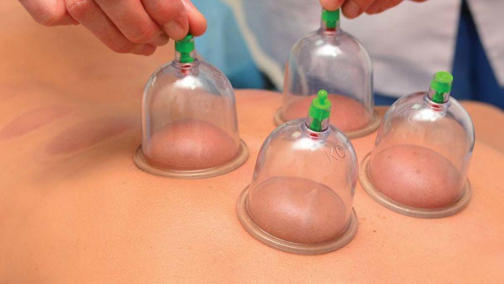 7 Manfaat Luar Biasa Bekam yang Perlu Kamu Tahu