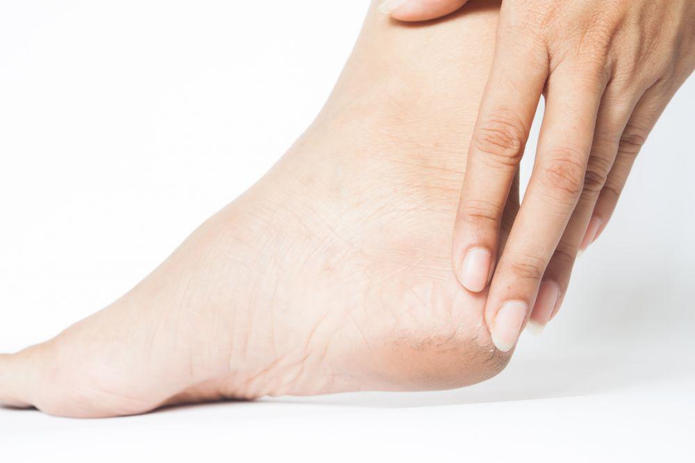 Gak Ribet, 7 Cara Ini Ampuh Atasi Kulit Kaki Kering dan Pecah-pecah