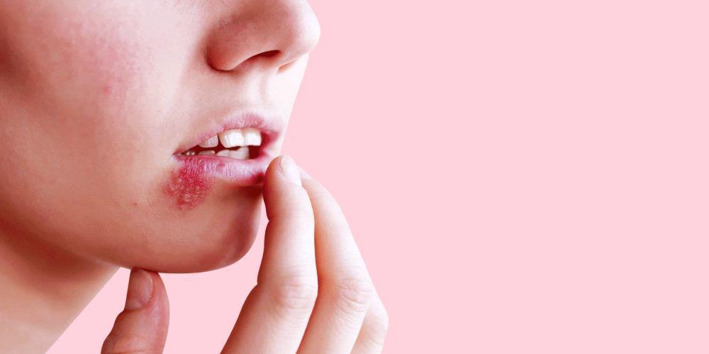 8 Gejala Penyakit Herpes yang Harus Dikenali dan Diwaspadai!