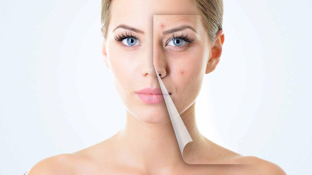 7 Kandungan Pada Label Kosmetik Ini Ampuh Cegah Jerawat