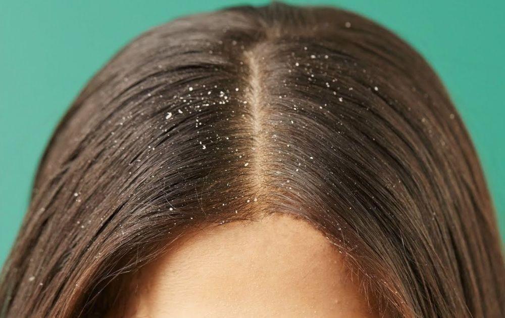 Sering Diabaikan, Ini 7 Penyebab Rambut Berketombe yang Umum Terjadi!