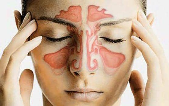 Tidak Disangka, 7 Hal Berikut Ternyata Bisa Sebabkan Sinusitis