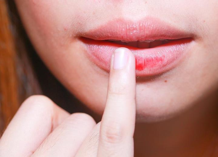Coba Lakukan 7 Cara Ini agar Bibir Hitam Dapat Kembali Memerah Alami