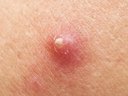 7 Penyebab Bisul Muncul di Bagian Tubuh yang Wajib Kamu Ketahui!