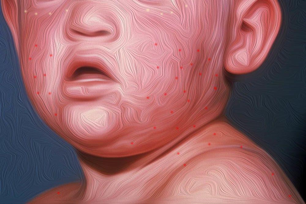 Gejala Penyakit Rubella dan 7 Fakta Penting Tentang Wabah Campak Ini