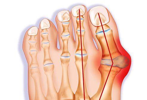 ilustrasi bunion (webmd.com)