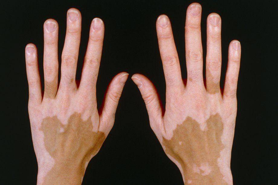 ilustrasi vitiligo (nhs.uk)