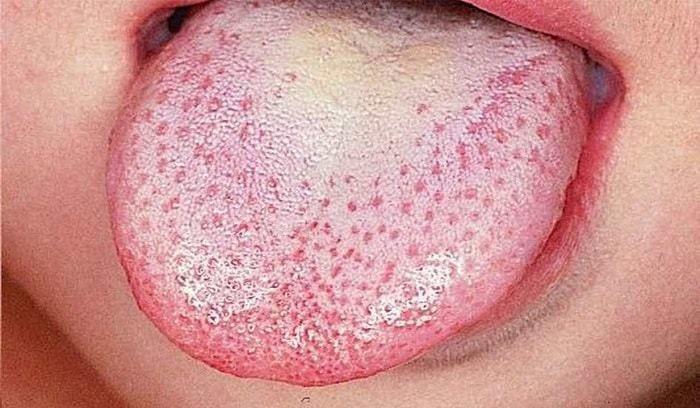 Mengenal Candidiasis, Ini 7 Fakta Infeksi Jamur yang Menyerang Kulit