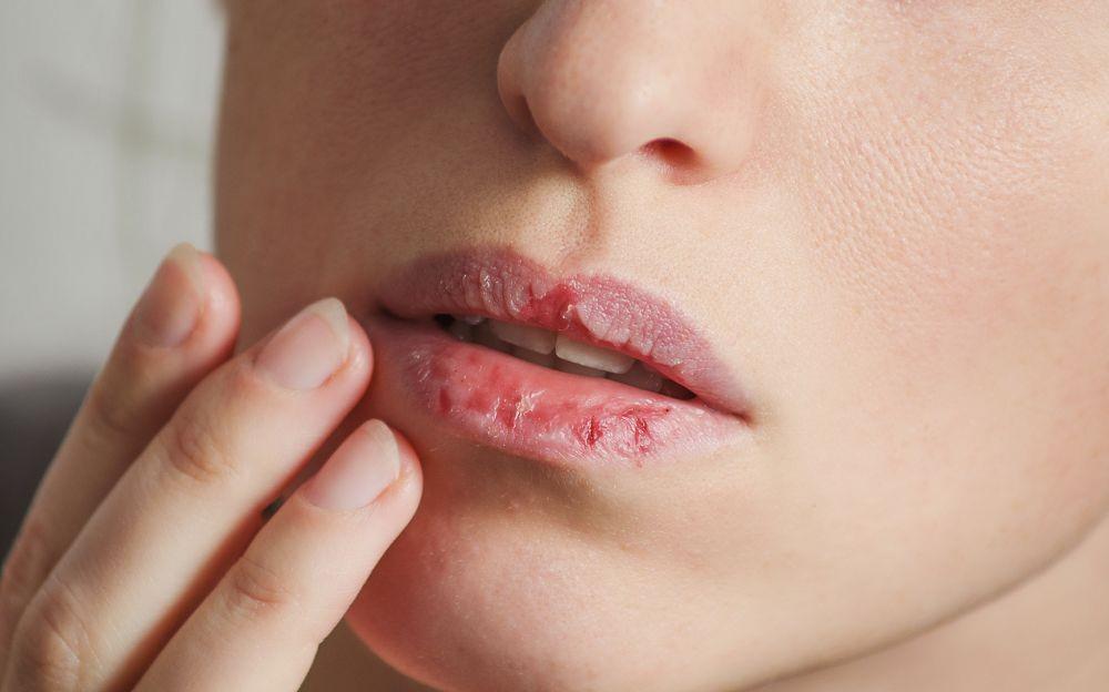 5 Cara Mengatasi Bibir Kering & Pecah-Pecah Selama Berpuasa