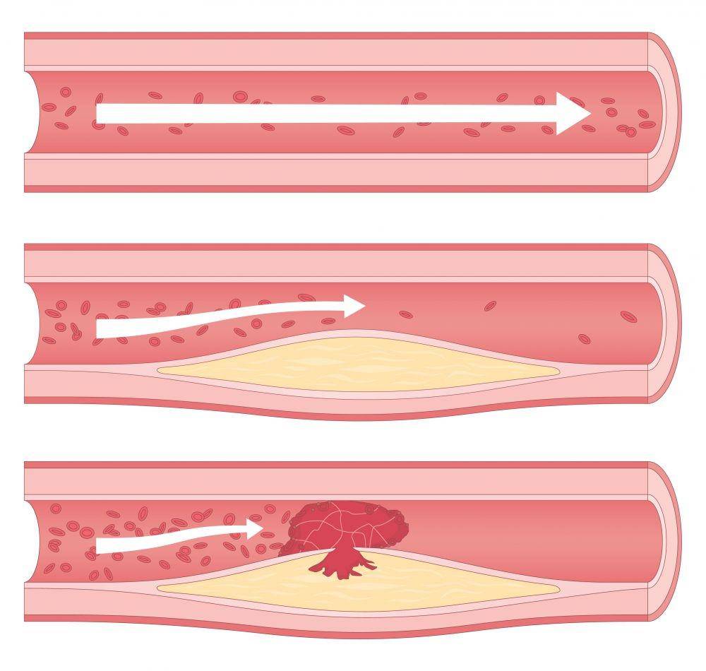 impella.com
