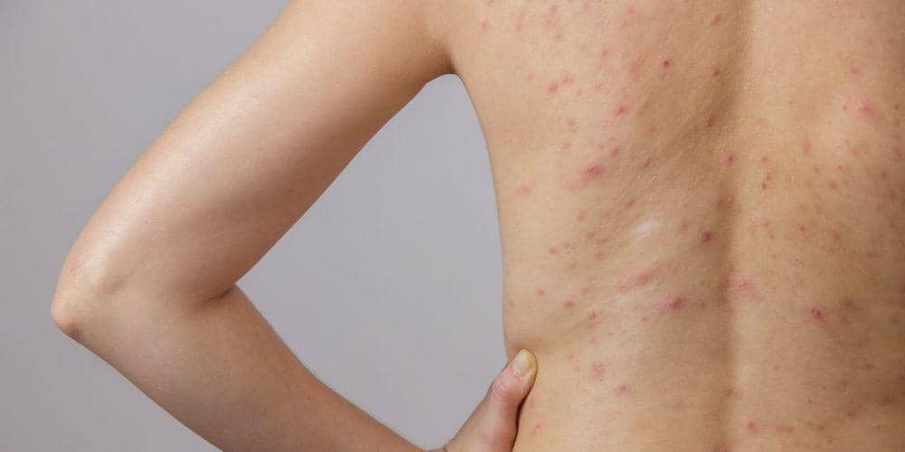 Ada Jerawat di Punggungmu? Ini 4 Bahan Alami yang Bisa Membasminya