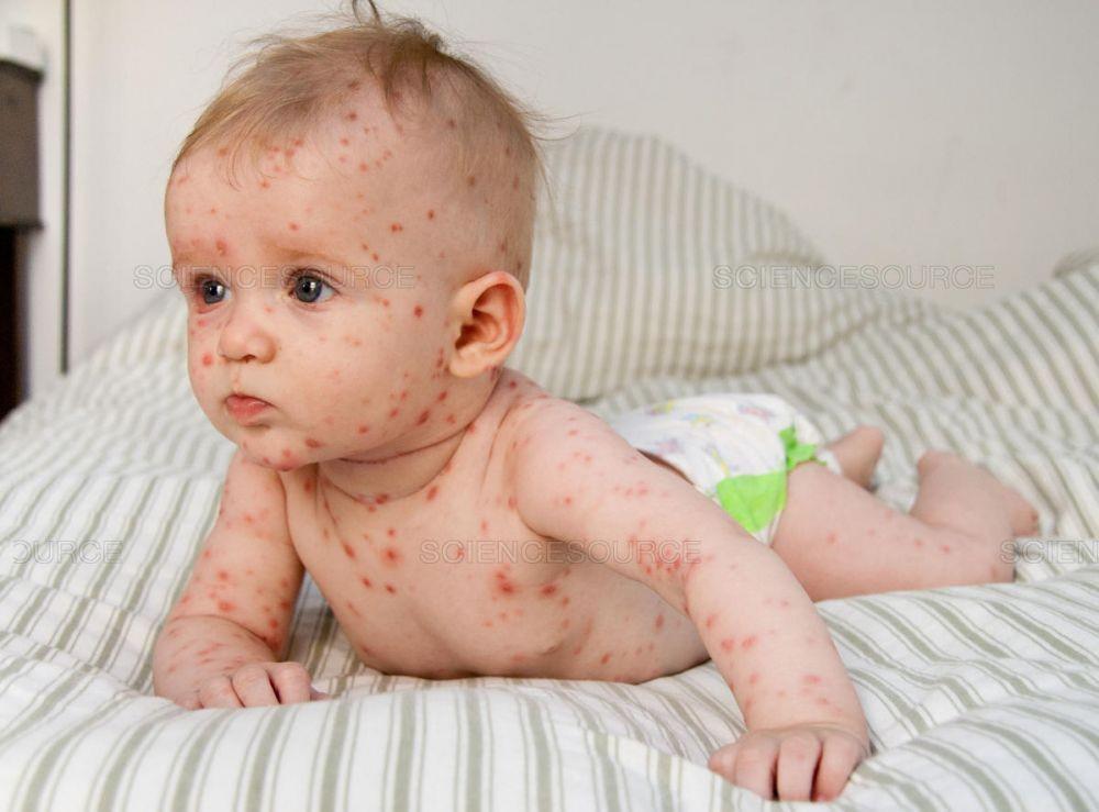 10 Jenis Penyakit Kulit Pada Anak yang Perlu Kamu Ketahui
