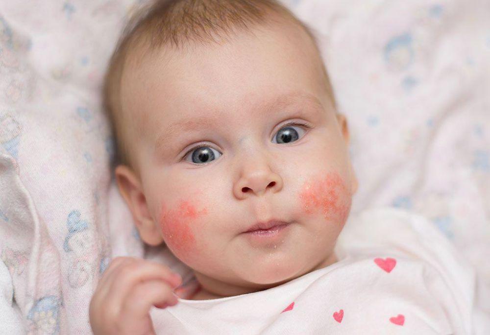 6 Gejala dan Penyebab Impetigo Pada Anak, Ibu Harus Tahu
