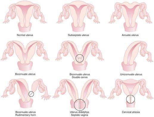 ilustrasi bentuk rahim (motherababy.com)