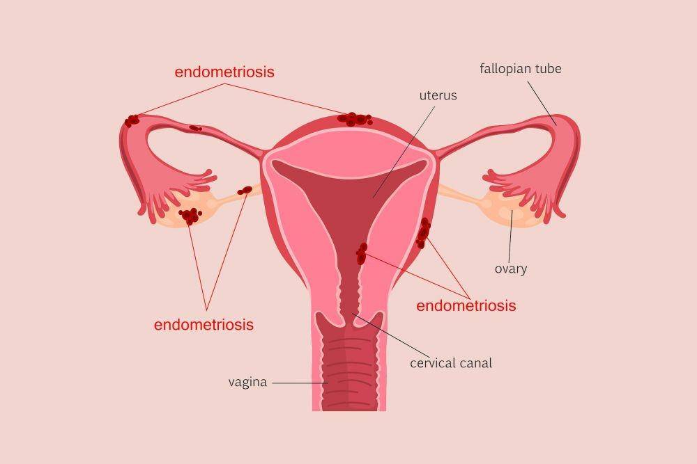 ilustrasi endometriosis (rd.com)