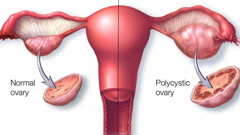 ilustrasi sindrom ovarium polikistik atau PCOS (infertile-life.com)