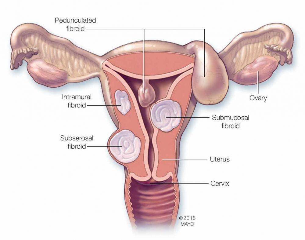ilustrasi fibroid rahim (mayoclinic.org)