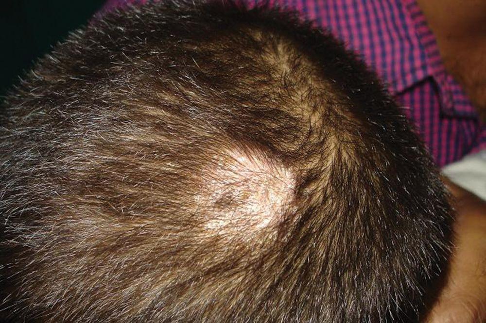 Tinea Capitis: Si Jamur Kepala yang Mengganggu Penampilan