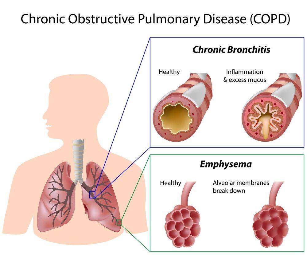 lungdiseasenews.com