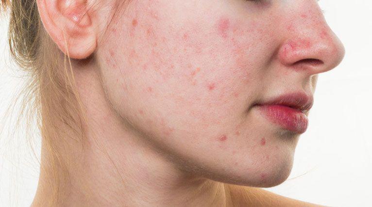 7 Penyebab Lain Kulit Alami Breakout Meski Rutin Pakai Skincare