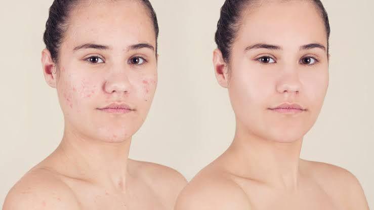Ingat 5 Tips Penting Ini Sebelum Menutupi Jerawat dengan Makeup