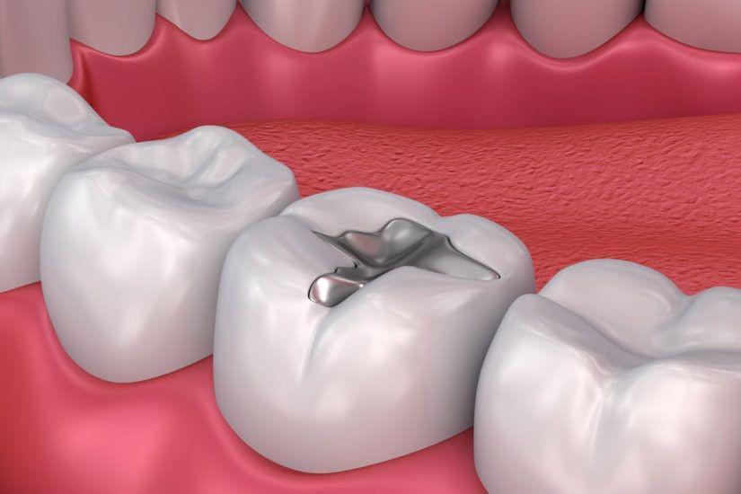 7 fakta prosedur dental amalgam, apakah aman untuk gigi?