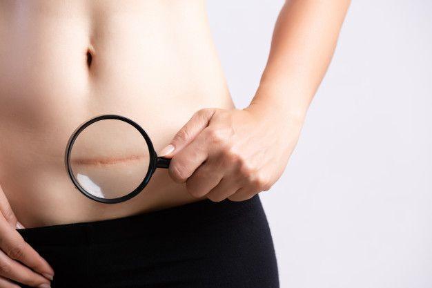 10 Cara Menghilangkan Bekas Luka Membandel dengan Cepat & Alami