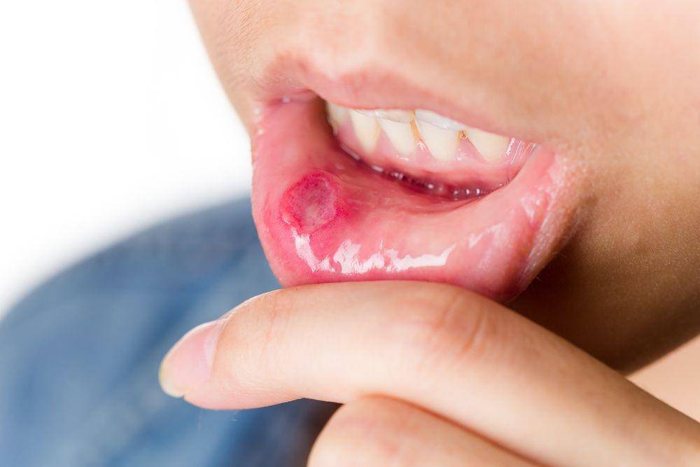 ilustrasi pemphigus vulgaris (alldaychemist.com)