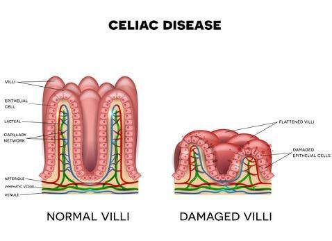 beyondceliac.org