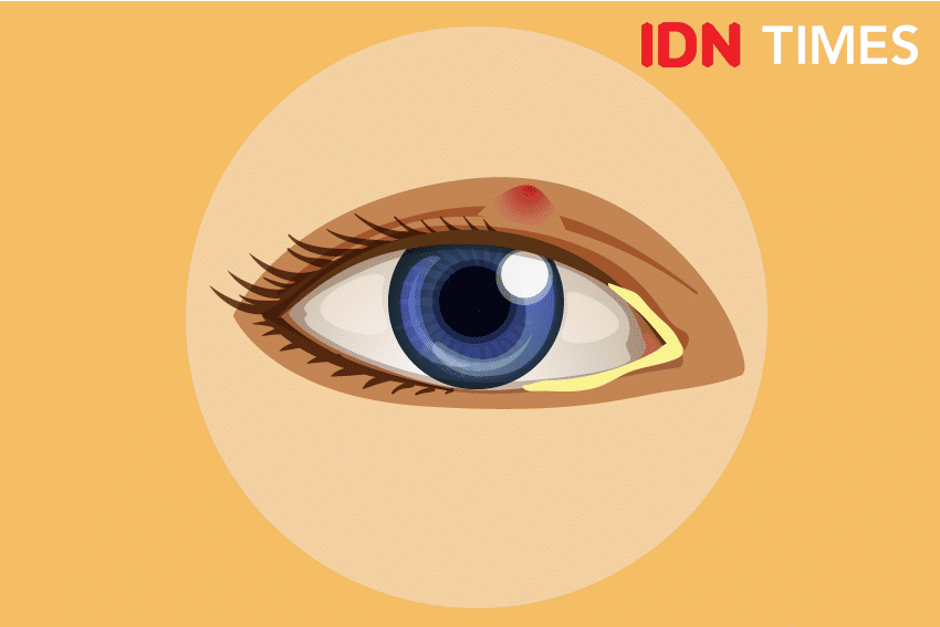 Ilustrasi bintitan. IDN Times/Izza Namira